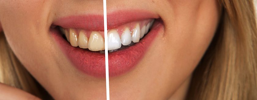 Clinique Dentaire Maizerets : pour subir un blanchiment dentaire